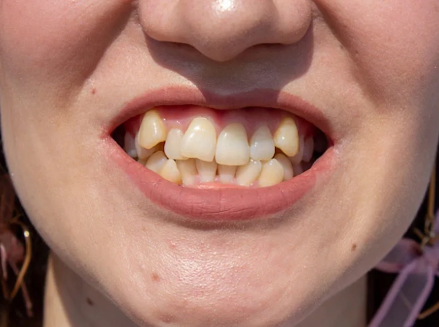 O que é o Invisalign e por que também é ideal para adultos?